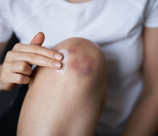 Fotografía de una persona limpiándose una herida en la rodilla después de una caída.