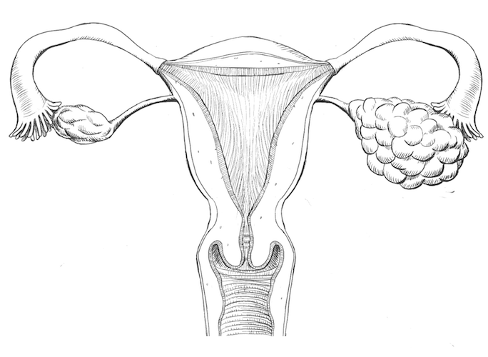 Uterus with Ovarian Cancer from Talc Powder