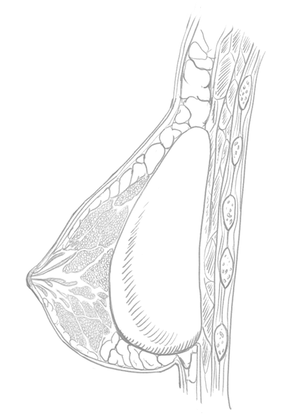 Illustration of Implant in Breast