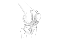 Exactech knee replacement inserts.
