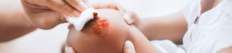 Burn Injury Lawsuits