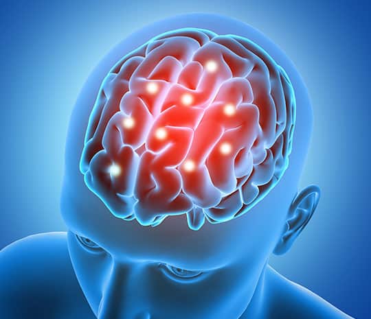 Fotografía de una exploración cerebral relacionada con una demanda por lesión cerebral traumática